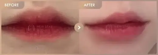 Lip fillers: before-and-after comparison at Newstar Clinic