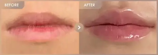 Lip fillers: before-and-after comparison at Newstar Clinic