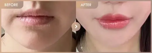 Lip fillers: before-and-after comparison at Newstar Clinic