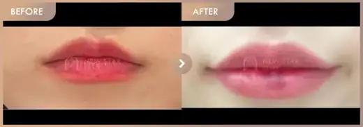 Lip fillers: before-and-after comparison at Newstar Clinic