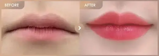 Lip fillers: before-and-after comparison at Newstar Clinic