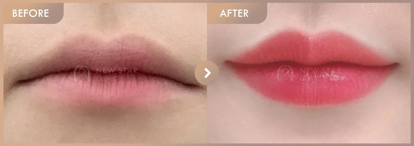 Lip fillers before-and-after photos at Newstar Clinic