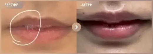 Lip fillers: before-and-after comparison at Newstar Clinic