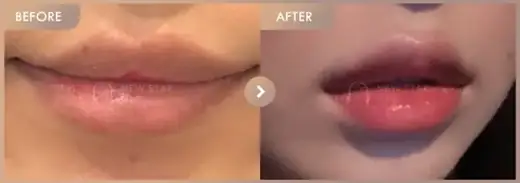 Lip fillers: before-and-after comparison at Newstar Clinic