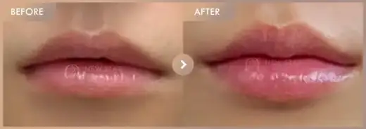 Lip fillers: before-and-after comparison at Newstar Clinic