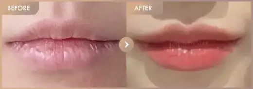 Lip fillers: before-and-after comparison at Newstar Clinic
