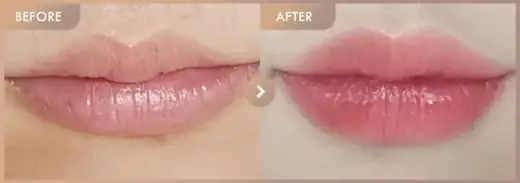 Lip fillers: before-and-after comparison at Newstar Clinic