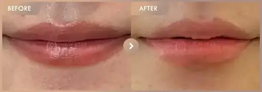 Lip fillers: before-and-after comparison at Newstar Clinic