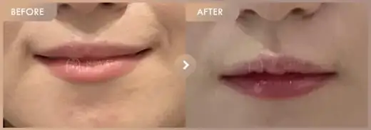 Lip fillers: before-and-after comparison at Newstar Clinic