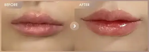 Lip fillers: before-and-after comparison at Newstar Clinic