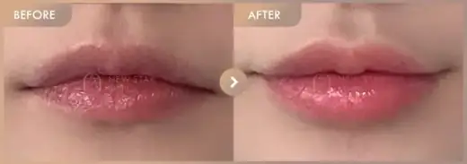 Lip fillers: before-and-after comparison at Newstar Clinic