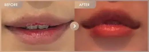 Lip fillers: before-and-after comparison at Newstar Clinic