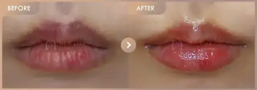 Lip fillers: before-and-after comparison at Newstar Clinic