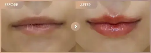 Lip fillers: before-and-after comparison at Newstar Clinic