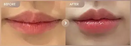 Lip fillers: before-and-after comparison at Newstar Clinic
