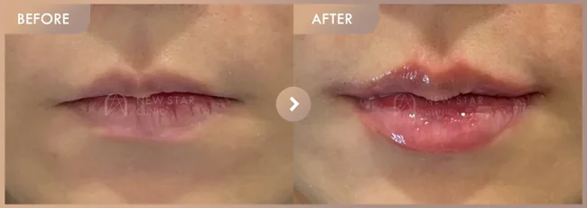 Lip filler: frontal shape and outline: before-and-after comparison at Newstar Clinic