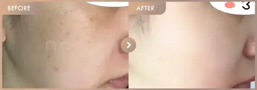 Ruby laser + Pico toning + Pico pore 5 sessions: before-and-after comparison at Newstar Clinic
