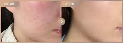 Pico toning + Rejuran: before-and-after comparison at Newstar Clinic