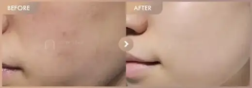 Ruby laser + Pico toning: before-and-after comparison at Newstar Clinic