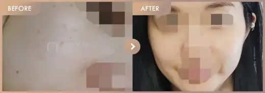 Ruby laser + Pico toning: before-and-after comparison at Newstar Clinic