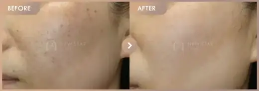 Pico toning + Ruby laser 10 sessions: before-and-after comparison at Newstar Clinic