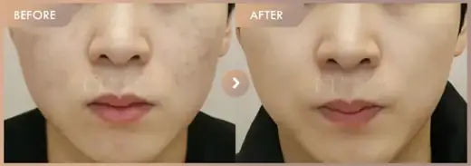 Potenza + Pico pore: before-and-after comparison at Newstar Clinic