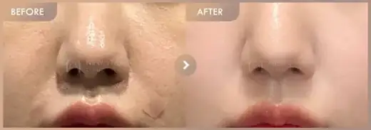 Pico toning + Potenza: before-and-after comparison at Newstar Clinic