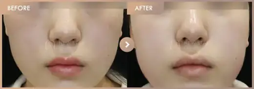 Pico toning + Excel V · 01: before-and-after comparison at Newstar Clinic