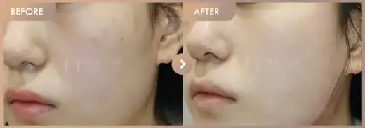 Pico toning + Excel V · 02: before-and-after comparison at Newstar Clinic