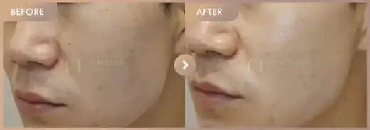 Excel V + Rejuran: before-and-after comparison at Newstar Clinic