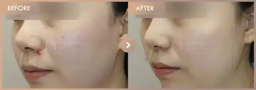Pico + Ruby + CO2: before-and-after comparison at Newstar Clinic