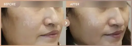 Pico + Ruby + Excel V: before-and-after comparison at Newstar Clinic