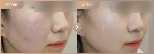 Excel V + Rejuran: before-and-after comparison at Newstar Clinic