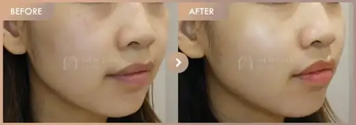 Ruby + Excel V + Rejuran + LILIEDm: before-and-after comparison at Newstar Clinic