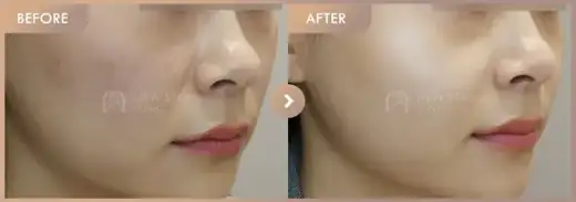 Pico + Excel V + Rejuran: before-and-after comparison at Newstar Clinic