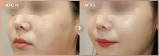 Pico + Excel V + Rejuran: before-and-after comparison at Newstar Clinic