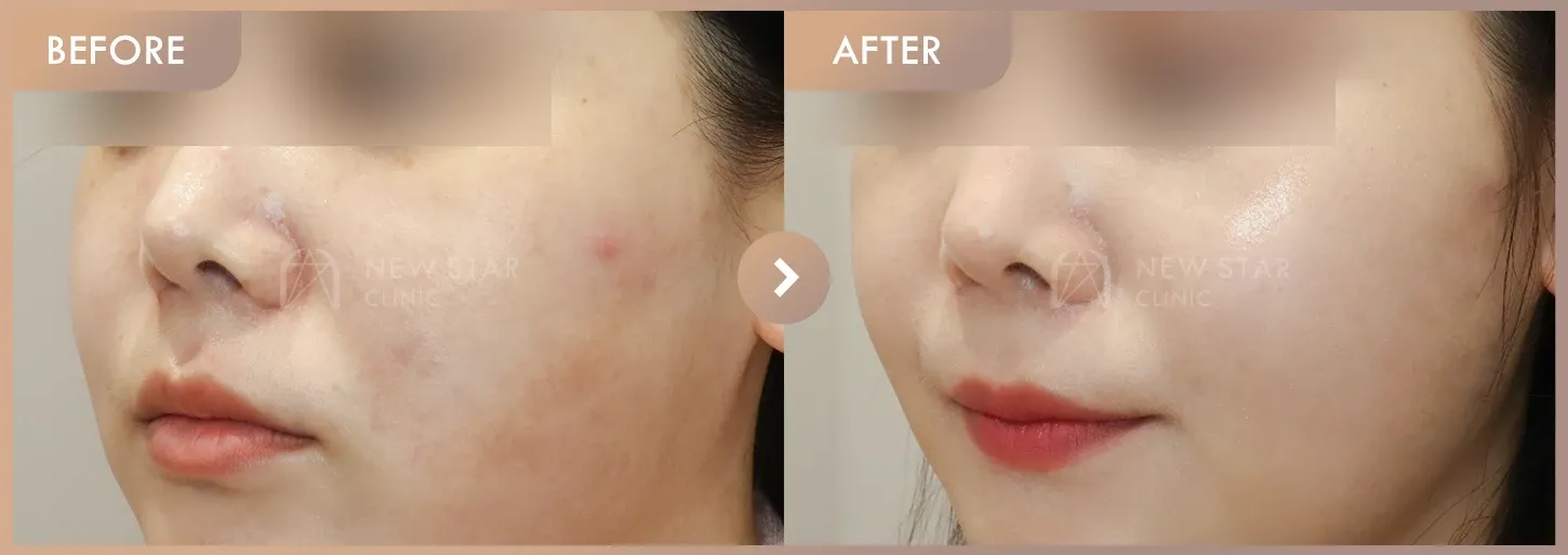 Pico + Excel V + Rejuran before-and-after photos at Newstar Clinic