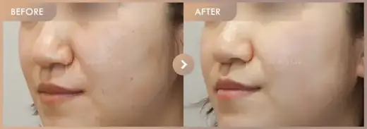 Pico + Excel V: before-and-after comparison at Newstar Clinic