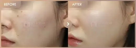 Potenza + Juvelook: before-and-after comparison at Newstar Clinic