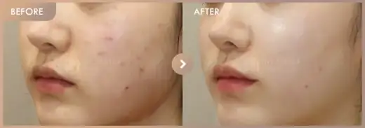 Pico + Excel V + Rejuran: before-and-after comparison at Newstar Clinic