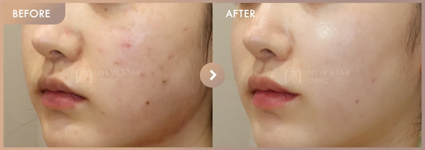 Pico + Excel V + Rejuran before-and-after photos at Newstar Clinic