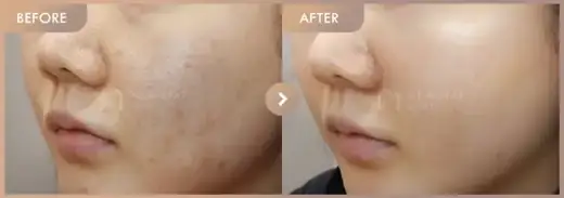 Excel V + Potenza + Juvelook: before-and-after comparison at Newstar Clinic