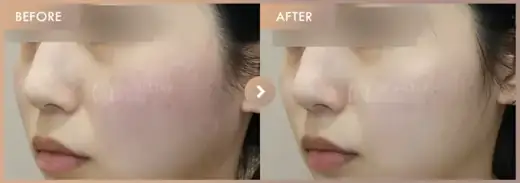 Excel V + Corege: before-and-after comparison at Newstar Clinic