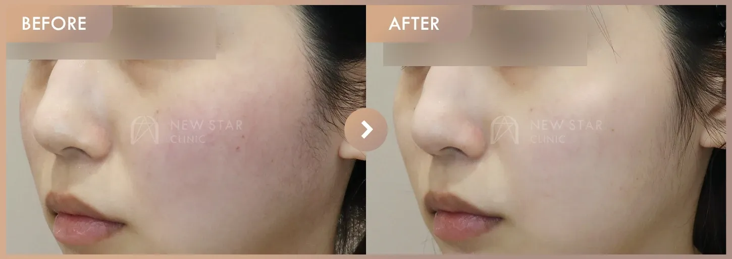 Excel V + Corege before-and-after photos at Newstar Clinic