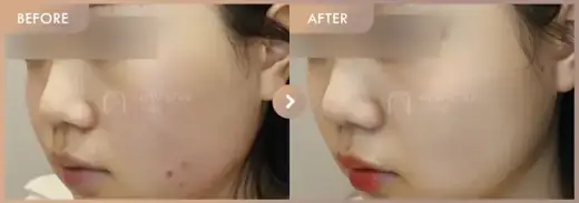 Pico + Excel V + LILIEDm: before-and-after comparison at Newstar Clinic