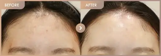 Aladdin peeling + Excel V: before-and-after comparison at Newstar Clinic