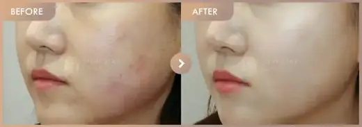 Excel V + Rejuran: before-and-after comparison at Newstar Clinic
