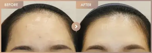 Aladdin peeling: before-and-after comparison at Newstar Clinic