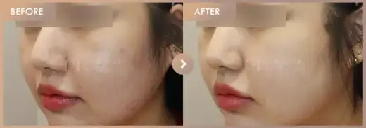 Aladdin peeling + Excel V: before-and-after comparison at Newstar Clinic