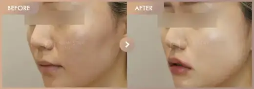Excel V + Potenza + Juvelook: before-and-after comparison at Newstar Clinic